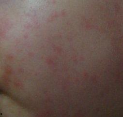 急疹照片,照片中的儿童健康警示